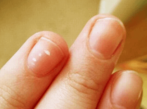 Что полумесяцы на ногтях говорят о вашем здоровье