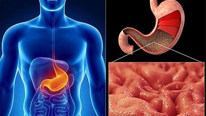 Повышенная кислотность желудка: натуральные средства для лечения