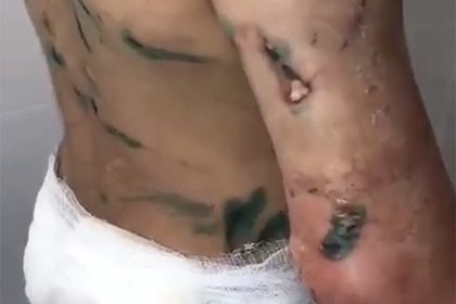 Врачи рассказали о состоянии изувеченной девочки из Ингушетии