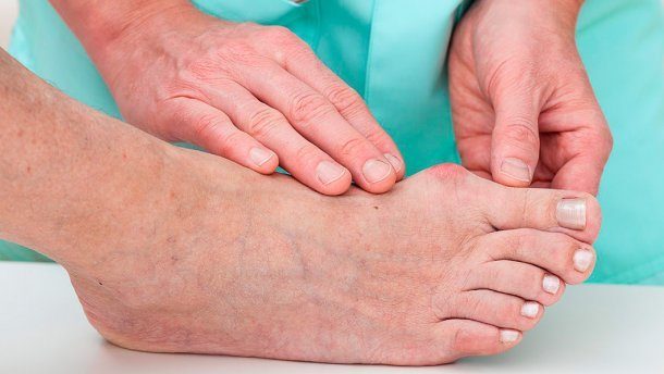 Самые распространенные мифы об подагру