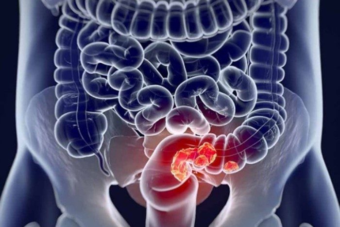 Названы 5 ранних симптомов рака кишечника