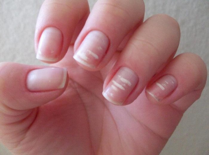 Специалисты объяснили, почему появляются белые пятна на ногтях