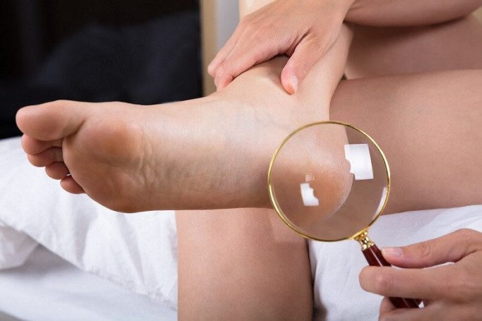 5 скрытых болезней, которые сопровождаются трещинами на пятках