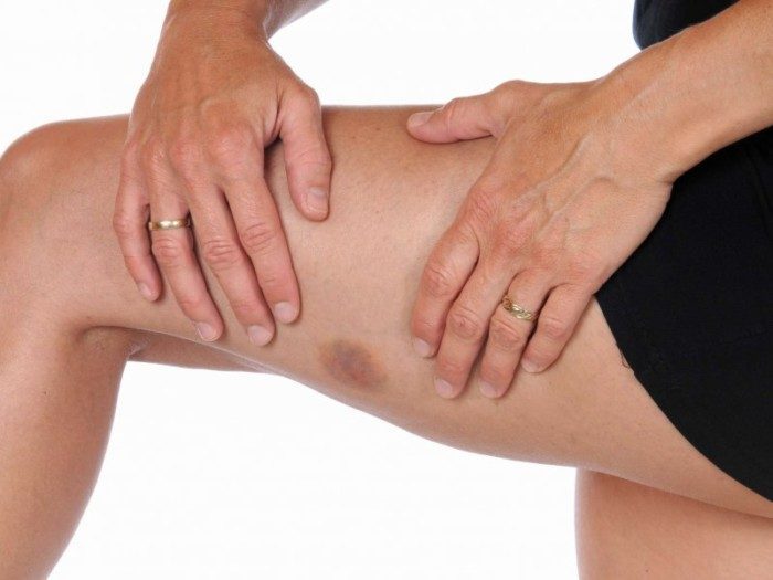 5 причин, почему у вас возникают синяки даже при незначительном ударе