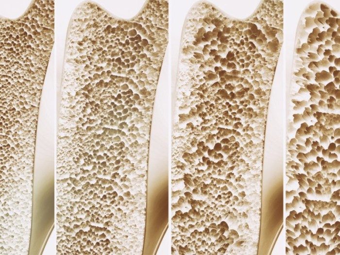 Профилактика остеопороза: 5 продуктов для здоровья костей