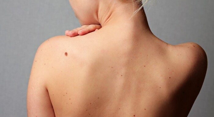 Специалист объяснила, как предотвратить развитие рака кожи и когда следует обратиться